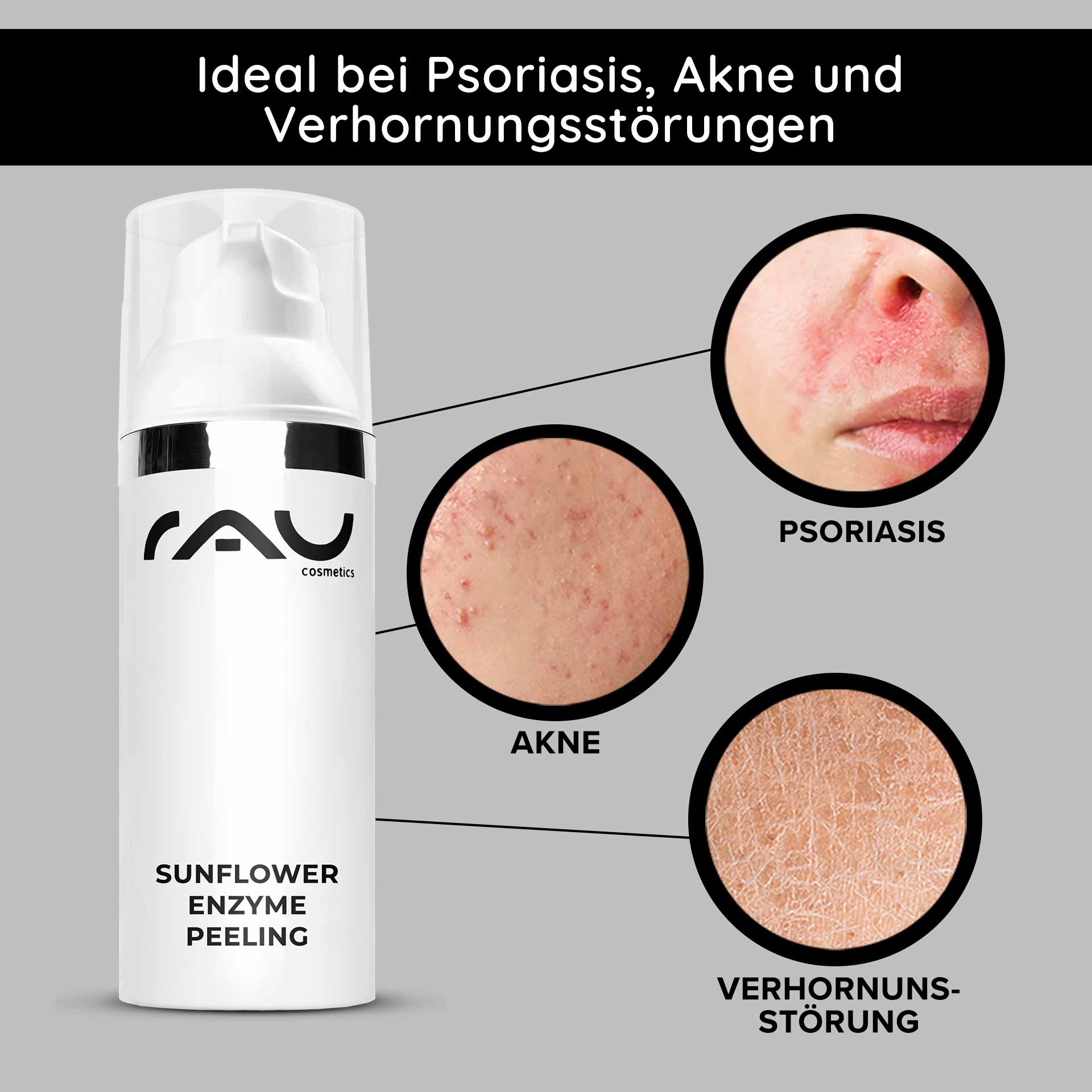 Sunflower Enzyme Peeling 50 ml Chemisches Enzymepeeling Verpackung des Sunflower Enzyme Peeling von RAU Cosmetics mit hervorgehobenen Hautproblemen: Schuppenflechte, Akne und Hyperkeratose.