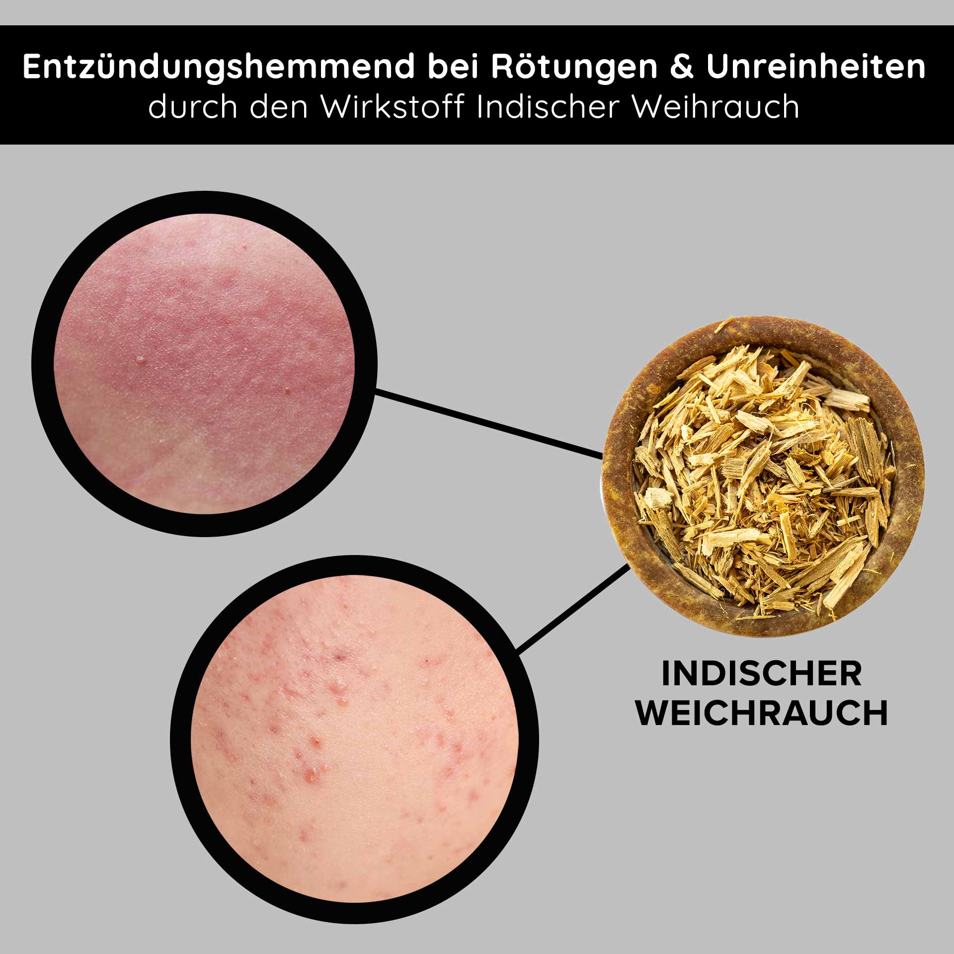 Tri-Peeling 50 ml Enzym- & Fruchtsäurepeeling Entzündungshemmendes Indischer Weihrauch zur Reduzierung von Rötungen und Unreinheiten, mit Nahaufnahmen von betroffener Haut.