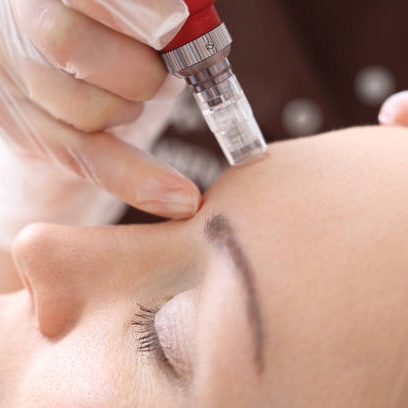microneedling_gegen_falten Hautbehandlung mit Microneedling zur Faltenreduzierung, Nahaufnahme einer Person, die ein Microneedling-Gerät auf die Stirn anwendet.