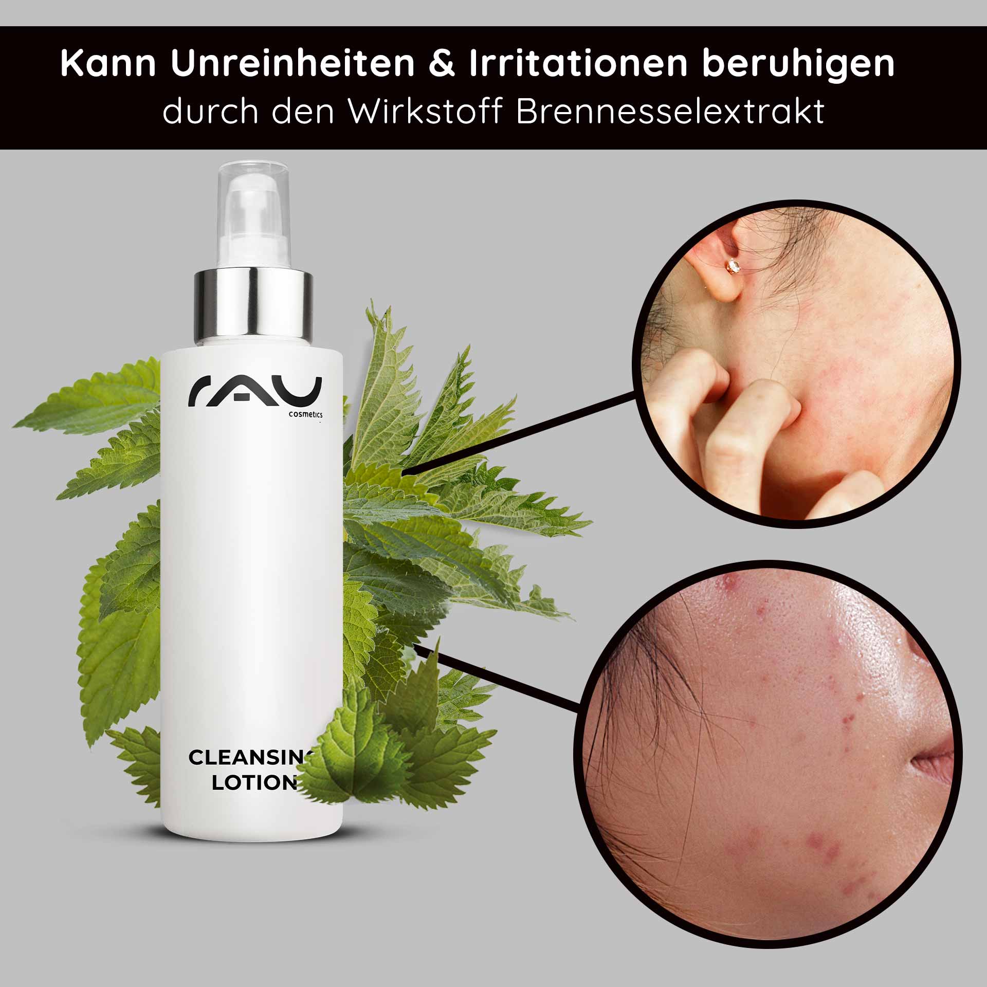 Cleansing Lotion 200 ml - gründliche Reinigungslotion Flasche der RAU-Reinigungslotion mit Brennnesselblättern im Hintergrund, die die Vorteile bei der Linderung von Unreinheiten und Reizungen hervorhebt und Nahaufnahmen von Haut mit Unreinheiten zeigt.