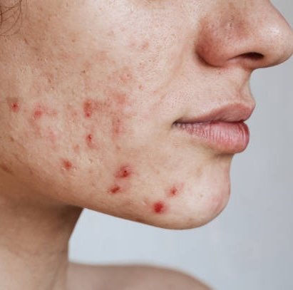 Akne im Erwachsenenalter – Nahaufnahme eines Gesichts mit entzündeten Pickeln und Mitessern im Wangenbereich.